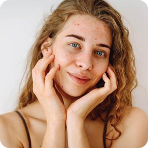 Akne och oren hud i ansiktet