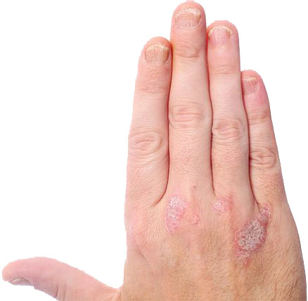 Haand med psoriasis